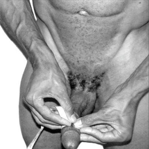 Vermessung des Penis vor der Vergrößerung.