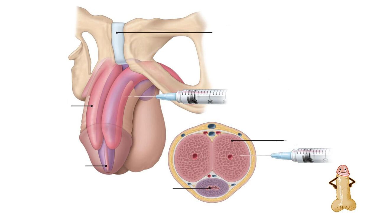 Hyaluronsäure-Injektionen zur Penisvergrößerung. 